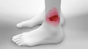 درمان زخم وریدی پا توسط فیزیوتراپی