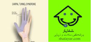 سندرم تنگی کانال کارپال