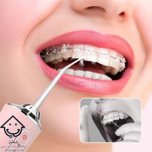 استفاده از واتر جت ORAL IRRIGATOR برند MDHL برای تمیز کردن دندان‌های ارتودنسی.