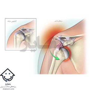تصویر دررفتگی قدامی و آناتومی شانه